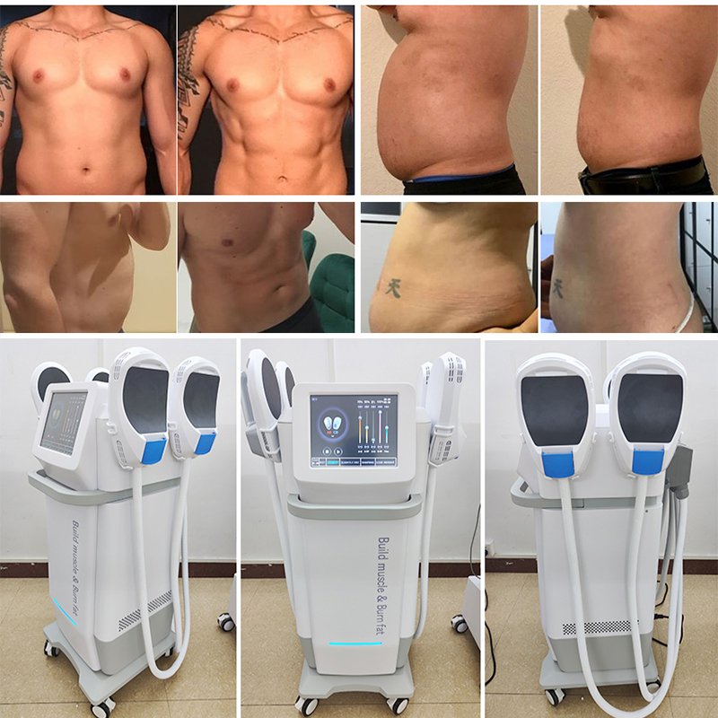 PERFECT SHAPE® NEO Body Sculpting Machine before and after
