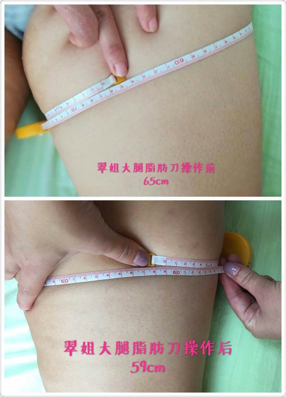 exilis sebelum dan sesudah