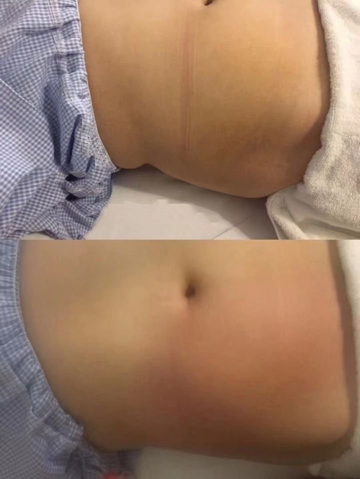 exilis sebelum dan sesudah