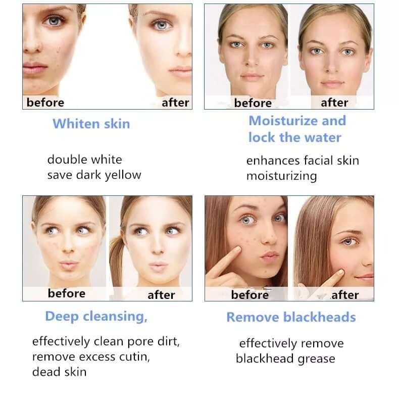 Before and after using Hydrafacial Machine_ Whiten