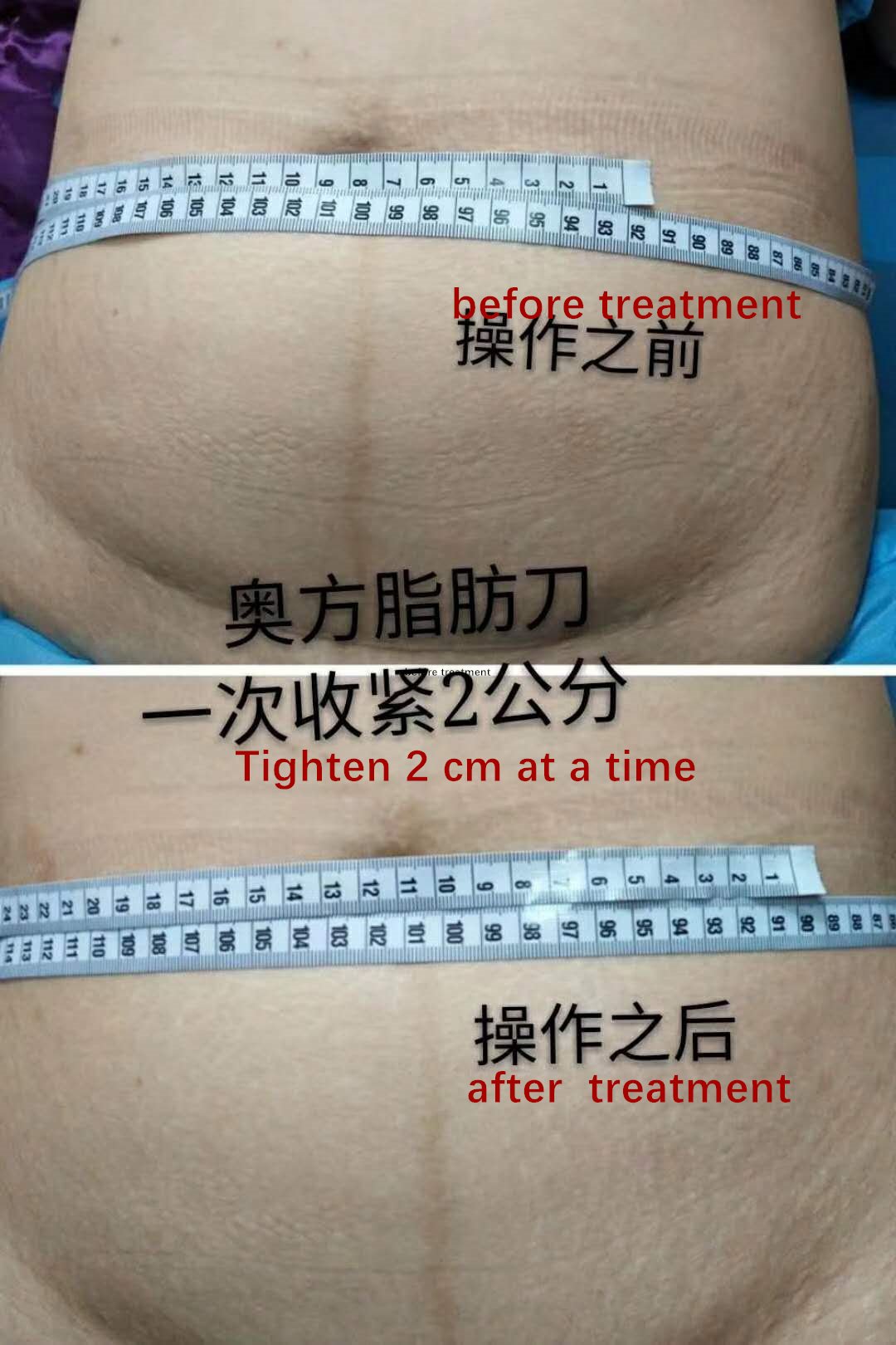 exilis sebelum dan sesudah