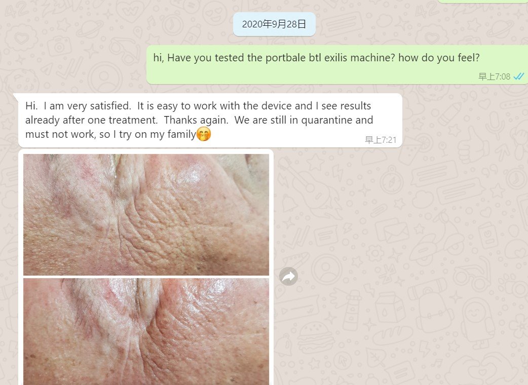 exilis sebelum dan sesudah