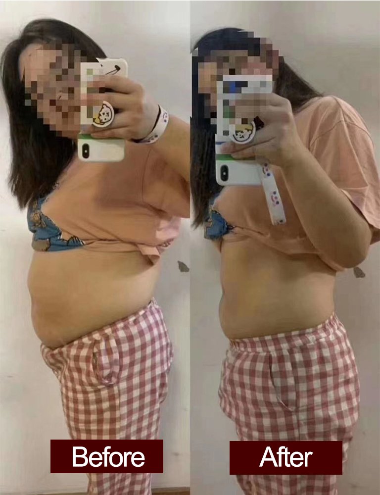 exilis sebelum dan sesudah