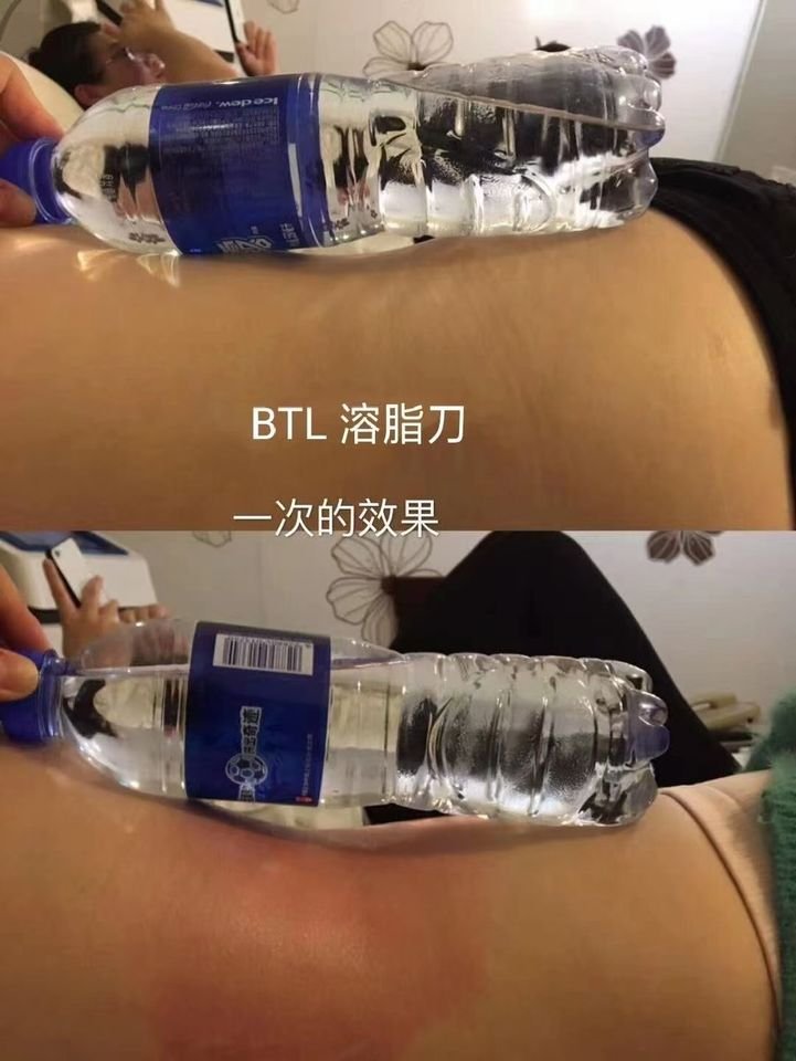 exilis sebelum dan sesudah