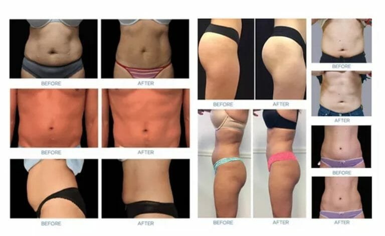 emsculpt treatment results