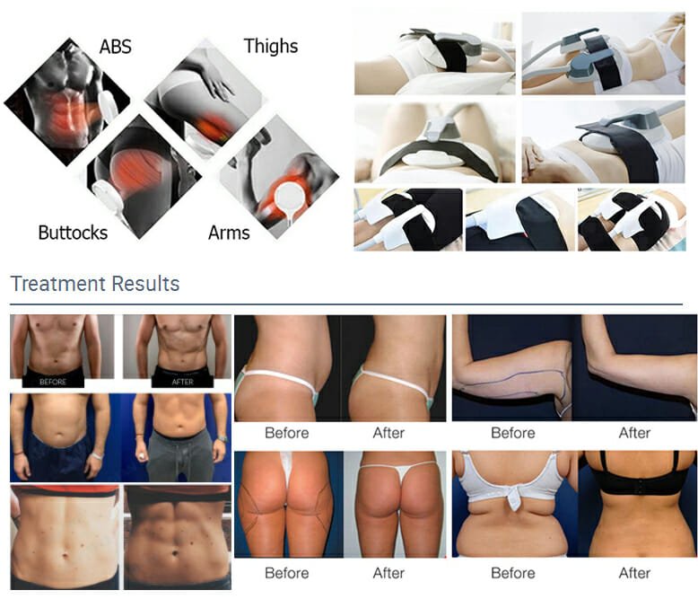 Emsculpt Before and After Results