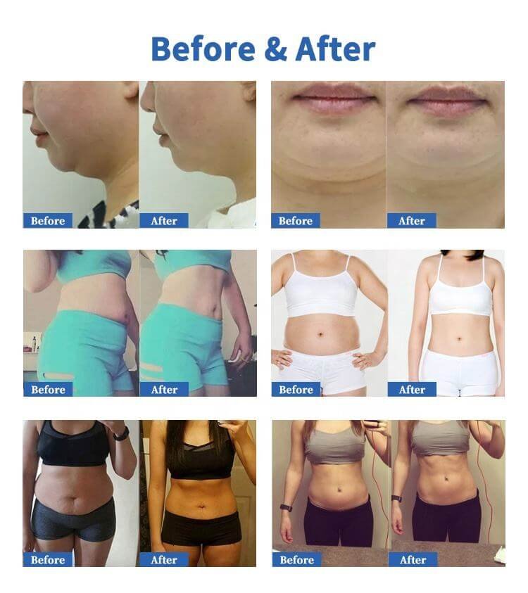 Αποτελέσματα Cryolipolysis Treamment