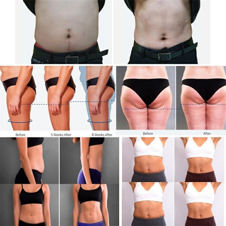 emsculpt neo treatment results