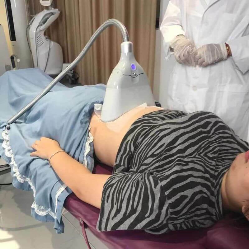 cryolipolysis body contouring