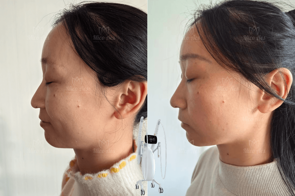 Volnewmer result (4)