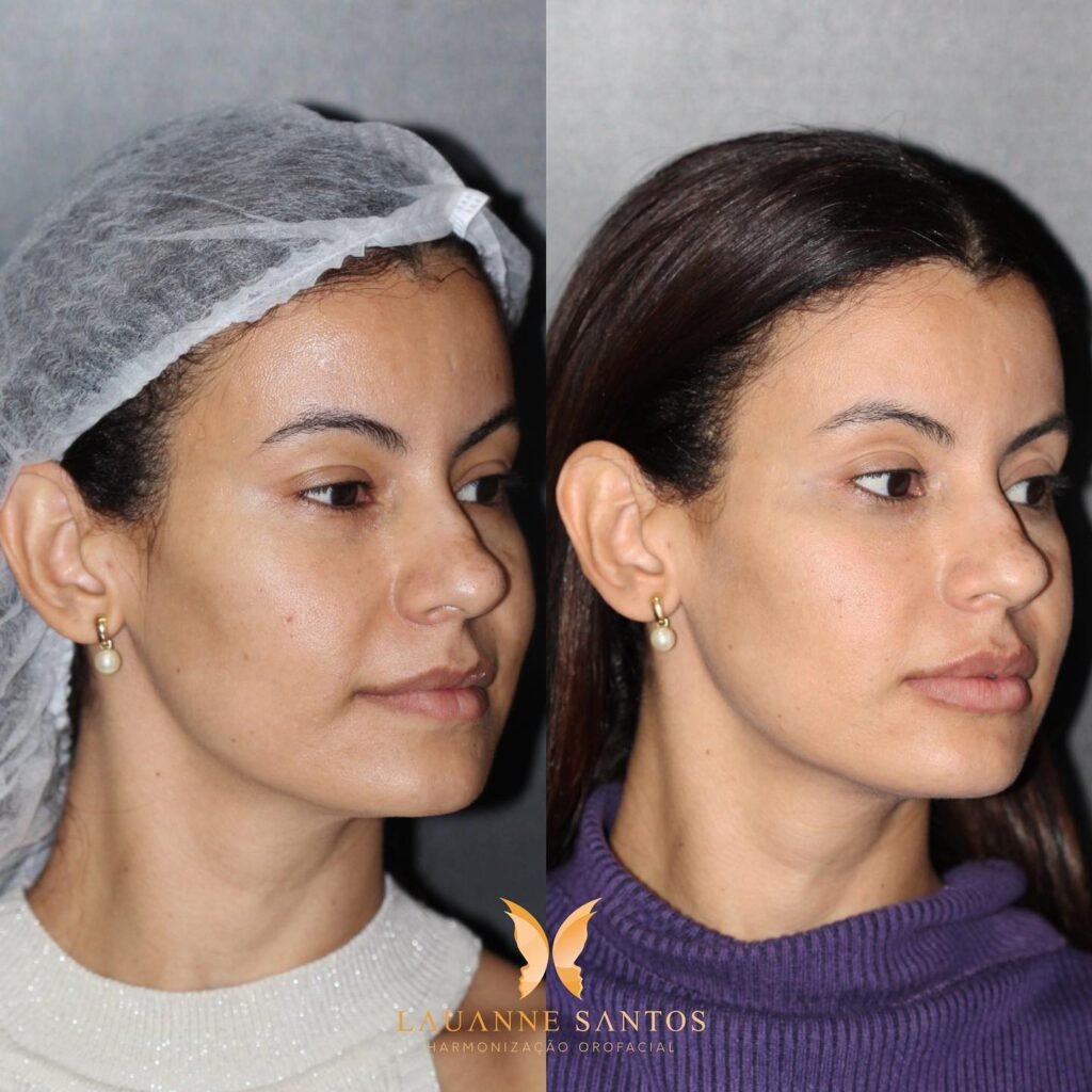 ultraformer MPT full face treatment