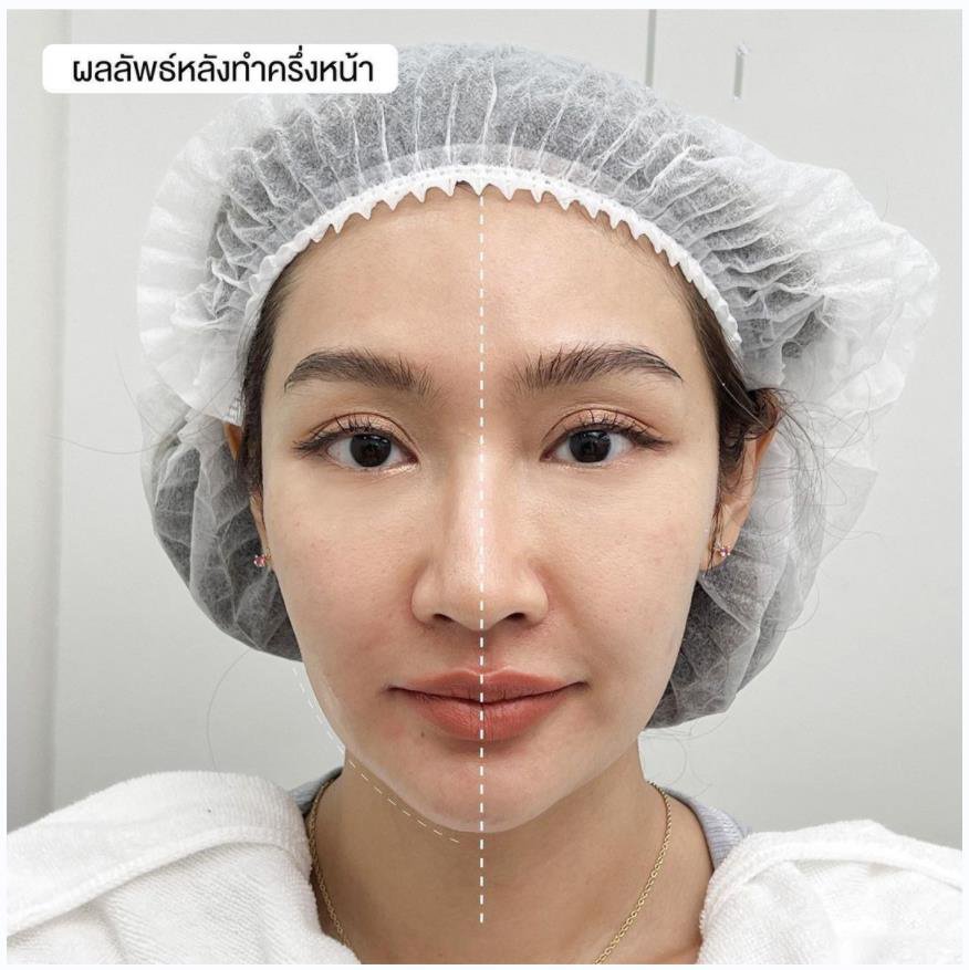 ultraformer mpt left and right for before and after comprasion