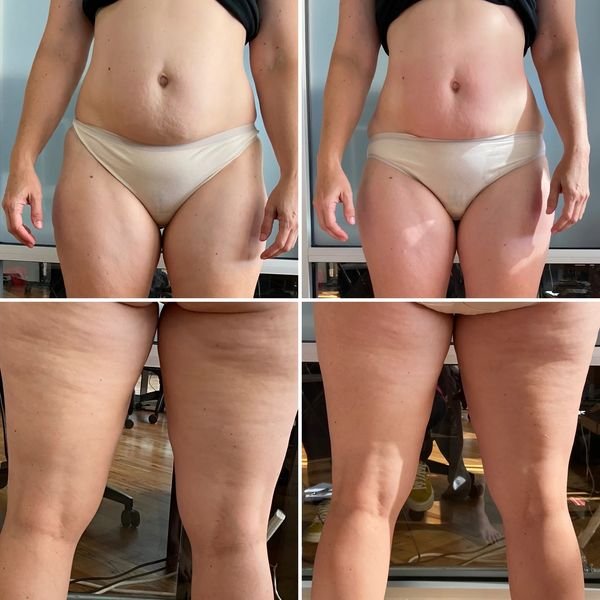 MPT hifu body contour before and after