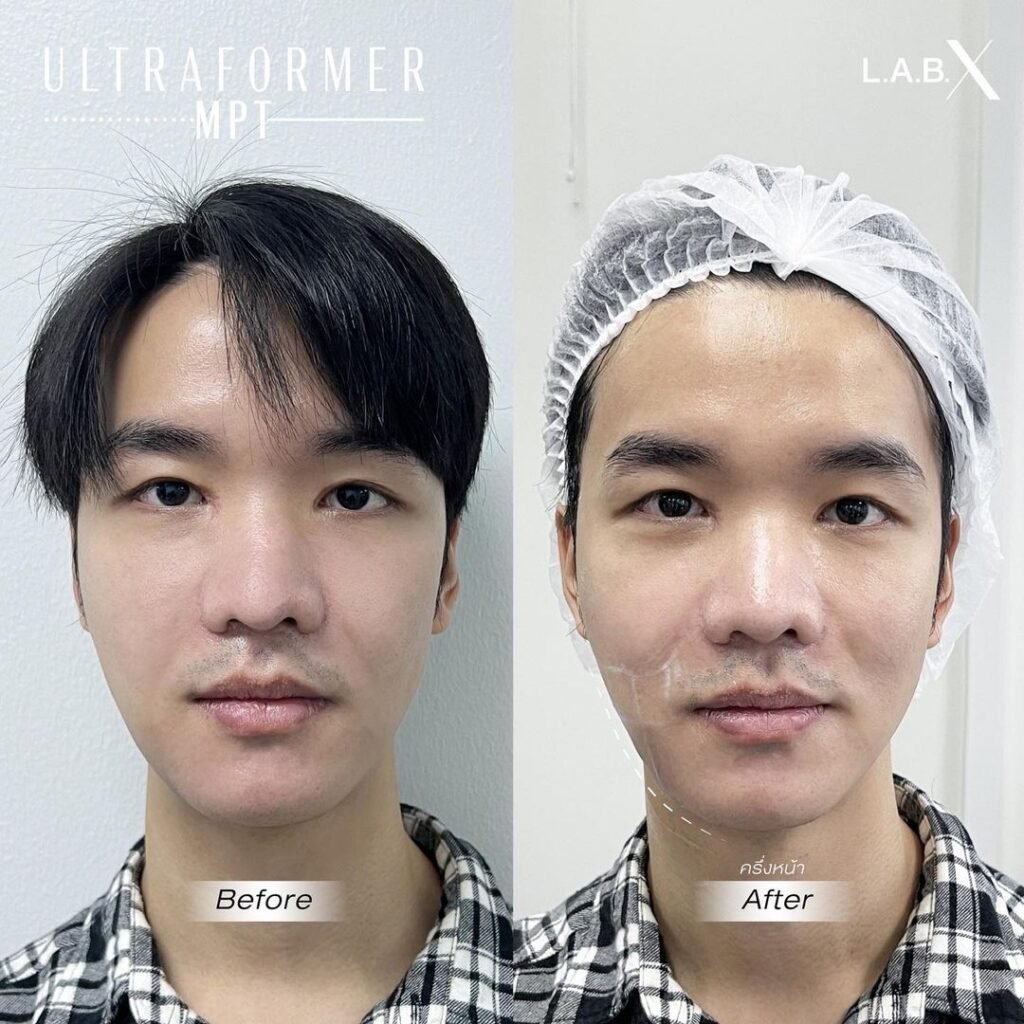 mpt hifu face lifting before and after