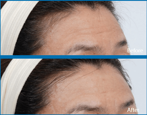 ultraformer mpt before and after forehead