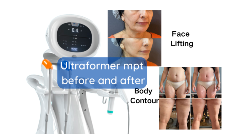 öncesi ve sonra ultra former mpt