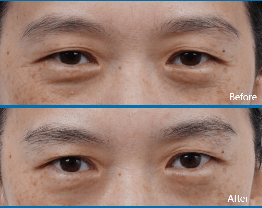ultraformer mpt before and after eyes