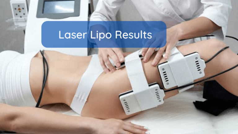 1 week lipo laser results