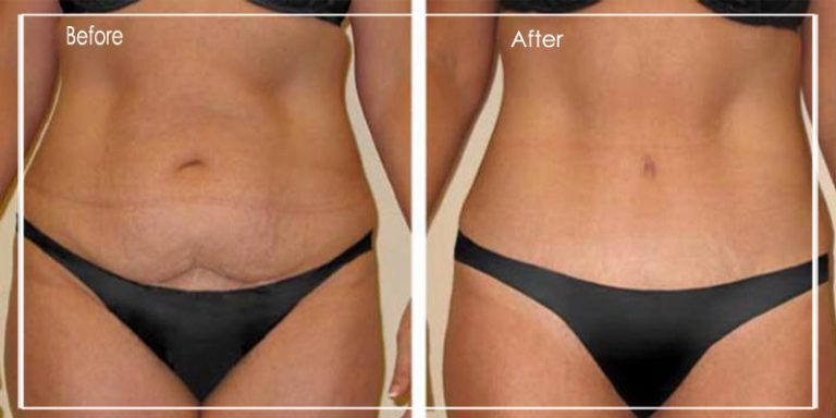 mesoterapia para el contorno corporal