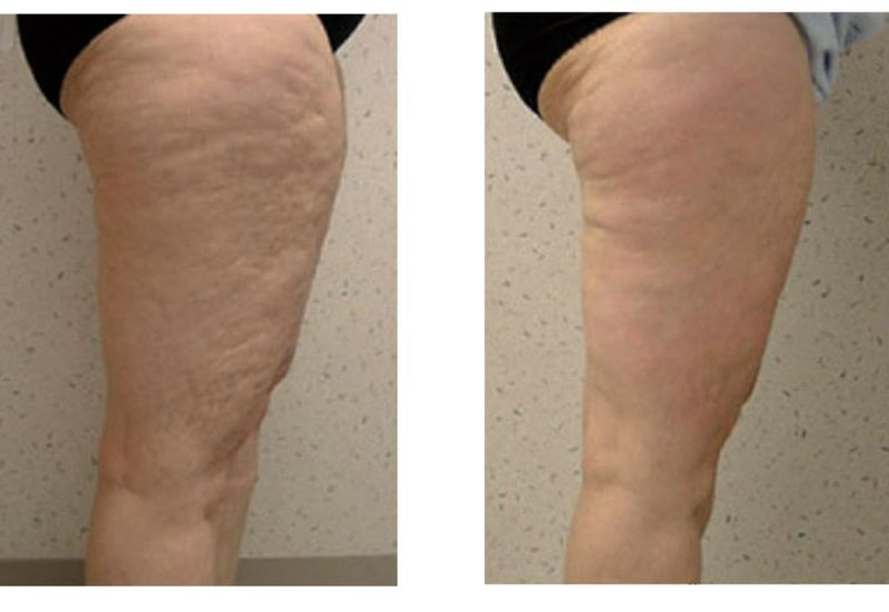 mesoterapia para reducir la celulitis