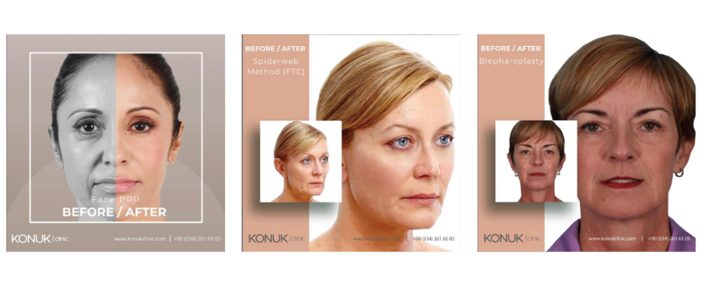 Antes y después de los resultados de la mesoterapia.