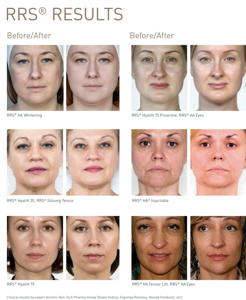 personas de diferentes edades que se benefician de la mesoterapia