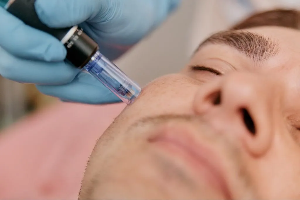 microneedling treatment