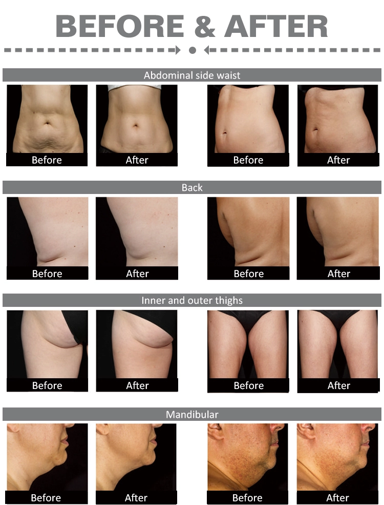 1060nm sculpsure laser slimming machine (2)