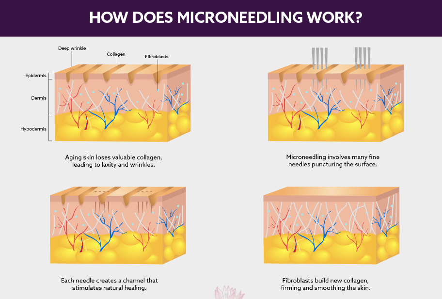 How Microneedling Works