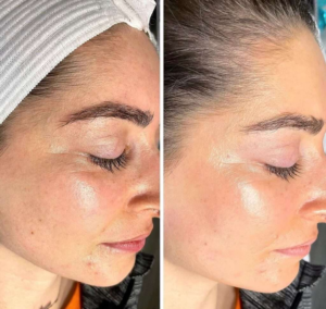 Hydrafacial for Hyperpigmentation