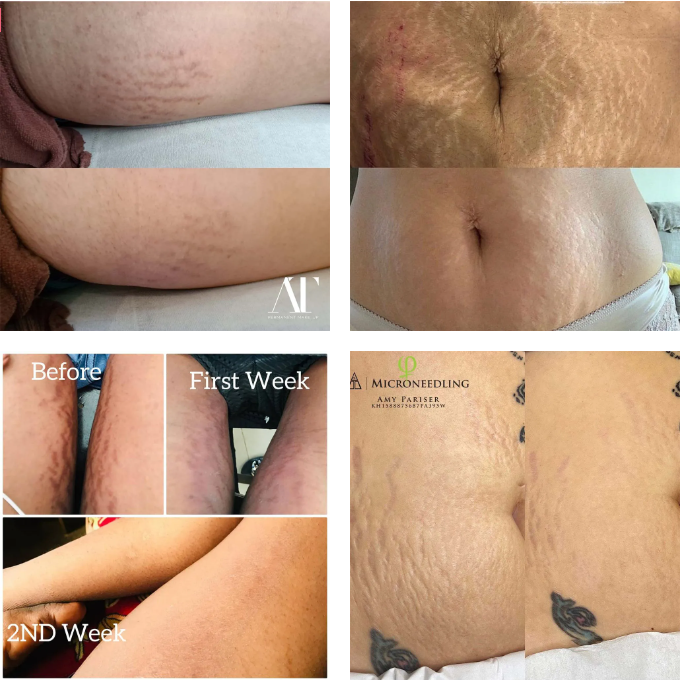 microneedling stretch mark before and after