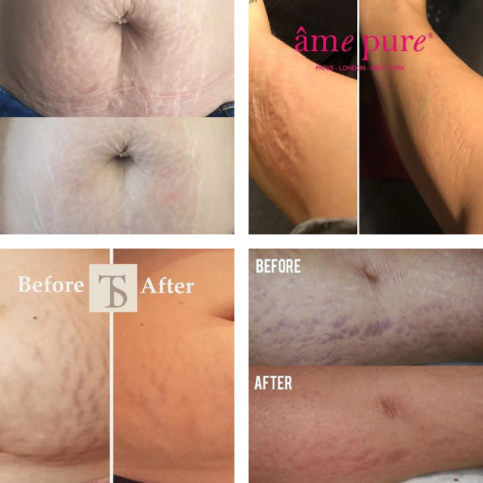 microneedling stretch mark before and after