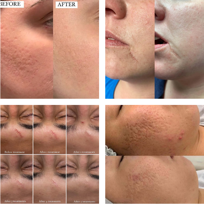 microneedling scars before and after