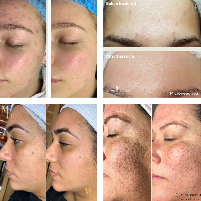 microneedling scars before and after
