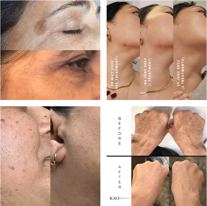microneedling for hiperpigmentation before and after