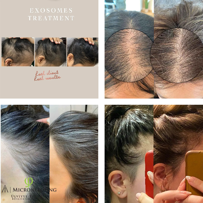 derma roller & derma pen for hair before and after