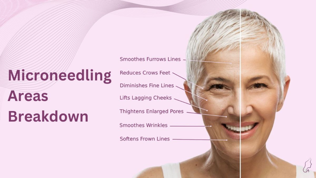 microneedling treatment areas