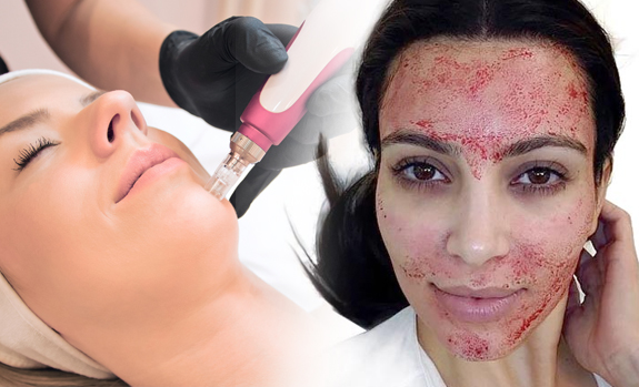 Co to jest mikroneedling?