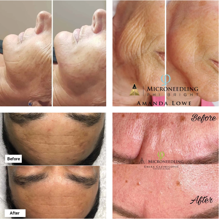 microneedling before and after wrinkles