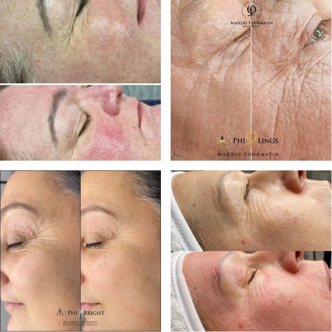 microneedling for eyes before and after