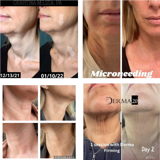 microneedling neck before and after