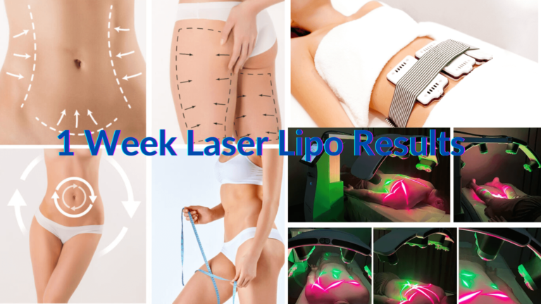 Résultats du lipo laser 1 semaine