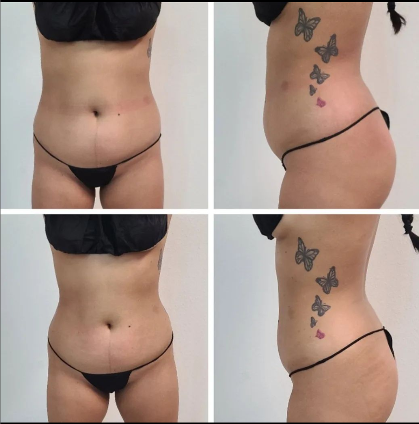 Emsculpt NEO Before and After | Real Patient Results 4