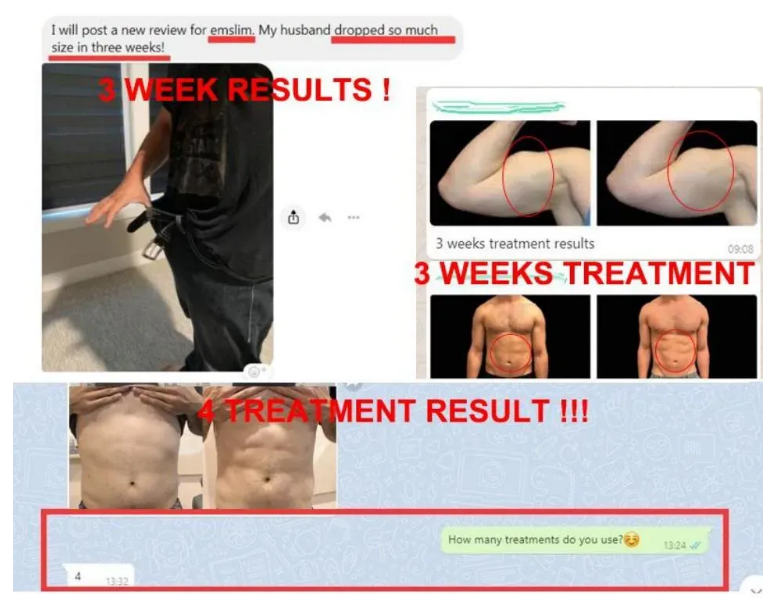 Emsculpt NEO Before and After | Real Patient Results 2