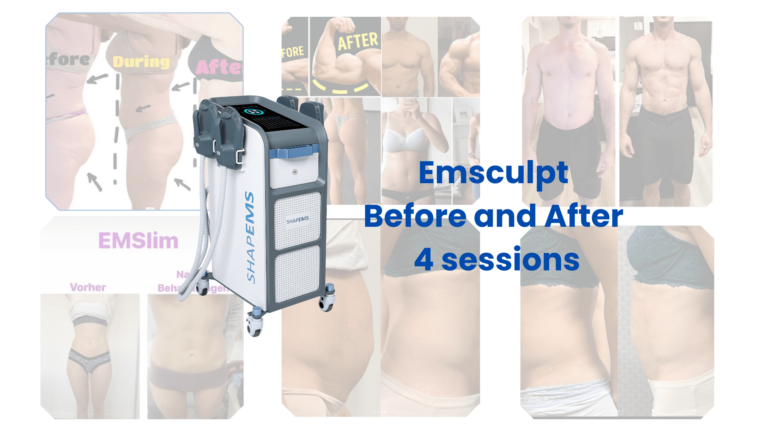 Emsculpt Avant et Après 4 séances