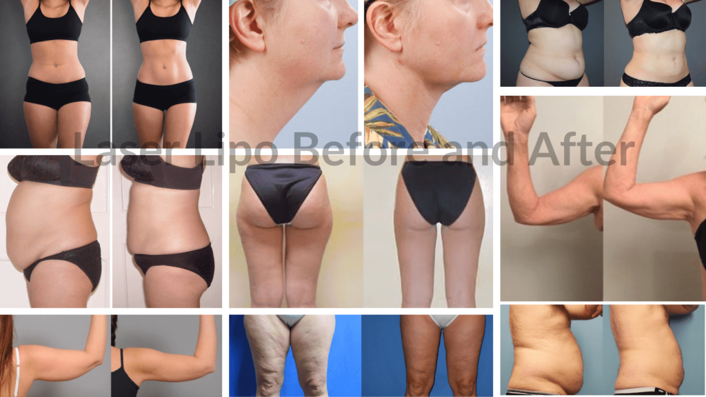 lipo laser before and after