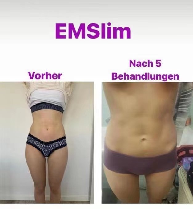 Emsculpt NEO Before and After | Real Patient Results 5