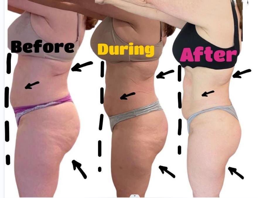 Emsculpt NEO Before and After | Real Patient Results 6