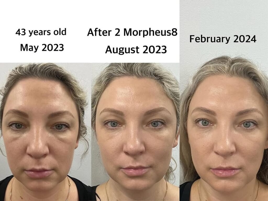 2-Morpheus8-treatments-reults