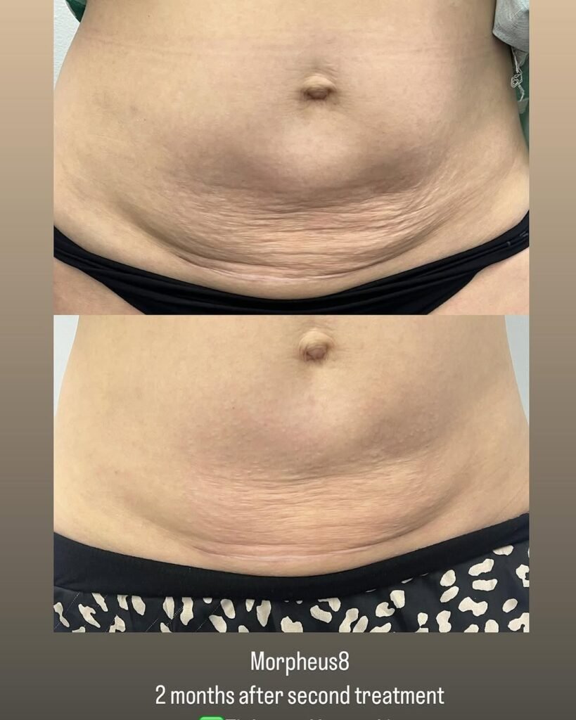 2-months-after-Morpheus8-on-body